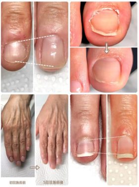 03-3　　ささくれ・皮膚あれ　育成前・結果